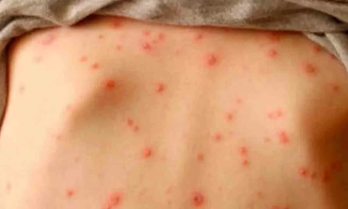 Sarampión: el Ministerio de Salud confirmó un caso en la Provincia