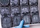 Argentinos lideran ensayo clínico de tratamiento contra un tipo de cáncer de cerebro