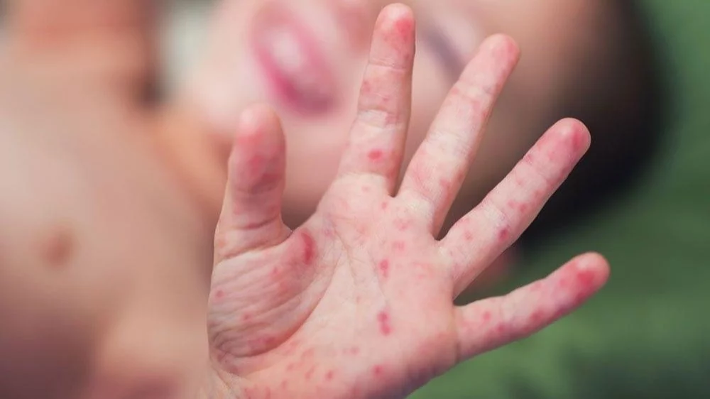 Enfermedad de manos, pies y boca: confirman rebrotes en menores de 5 años