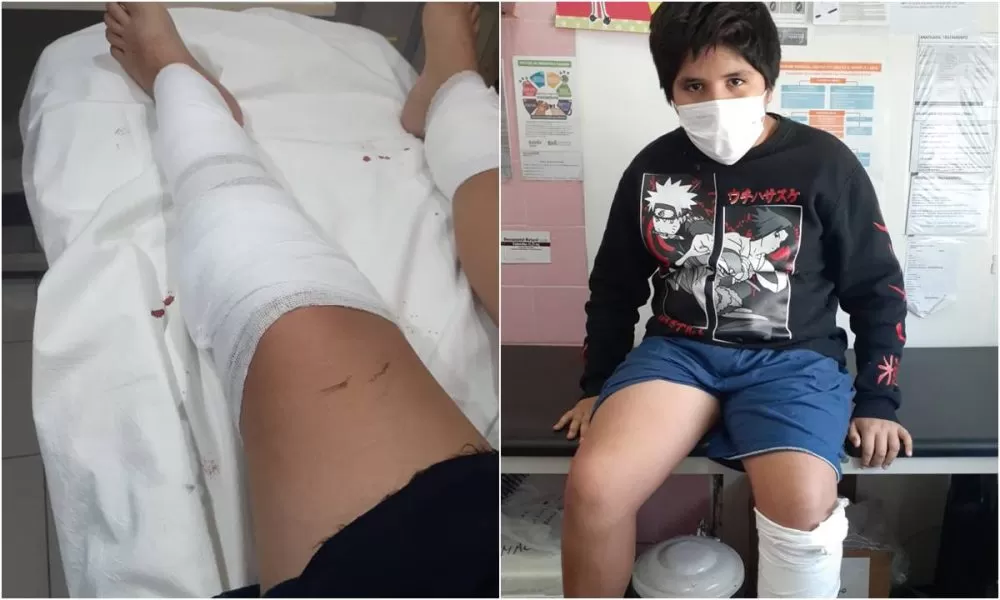 Un nene de 10 años fue ferozmente atacado por un pitbull