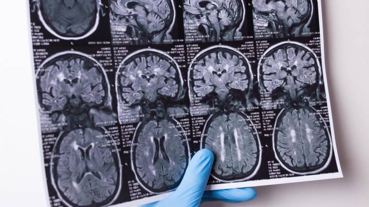Argentinos lideran ensayo clínico de tratamiento contra un tipo de cáncer de cerebro